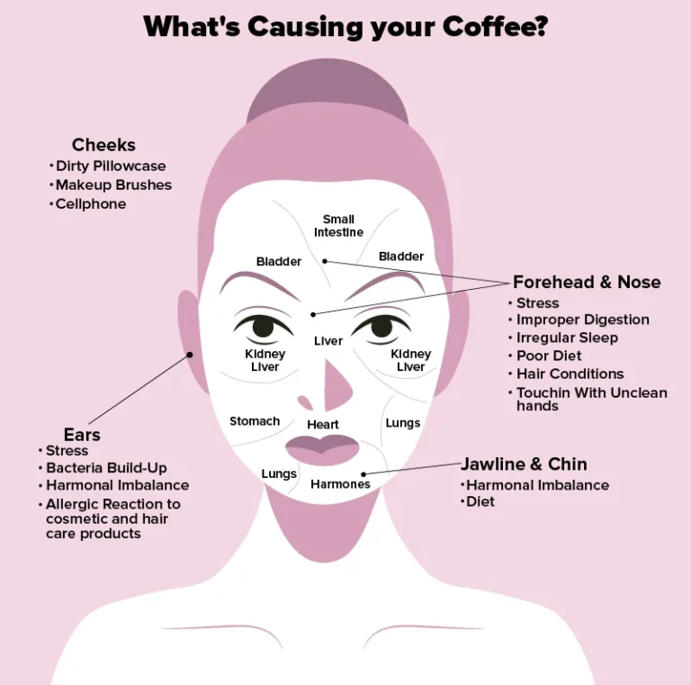 What Causes Forehead Acne