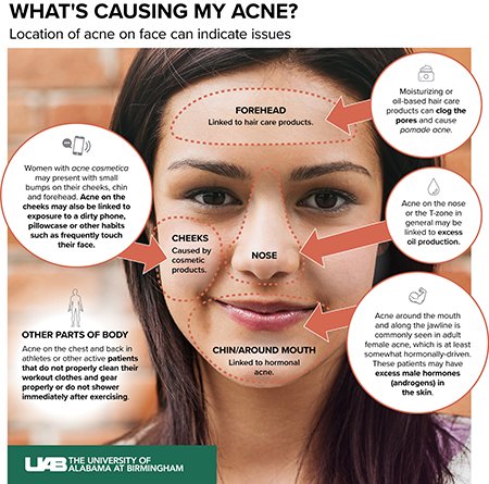 What Causes Acne?