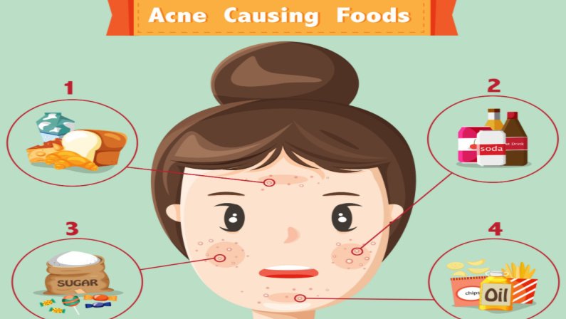 Does Diet Affect Acne