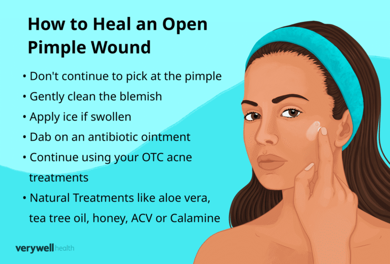 Should You Pop Pimples