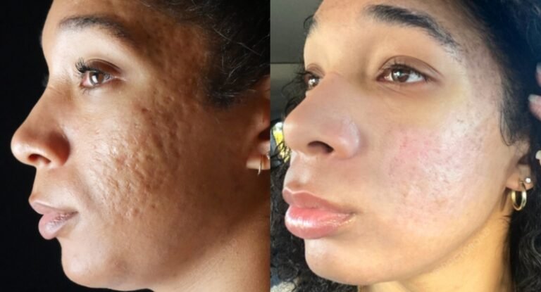 How Do You Get Rid Of Acne Scars