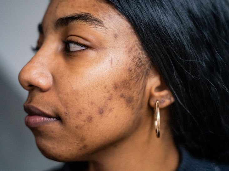 Can Acne Leave Permanent Scars