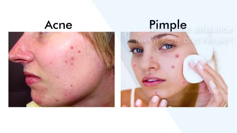 What Is The Difference Between Acne And Pimples