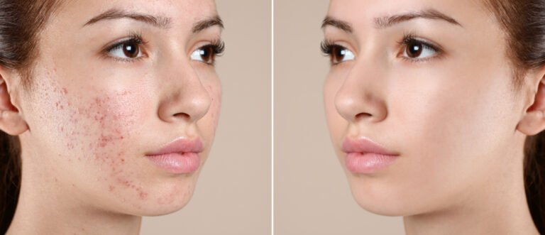 How Long Does Acne Take To Clear Up