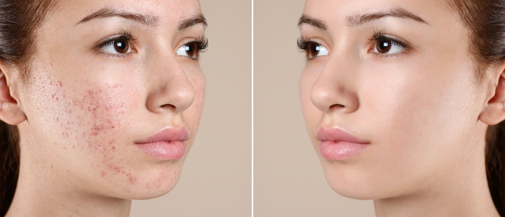 How Long Does Acne Take To Clear Up