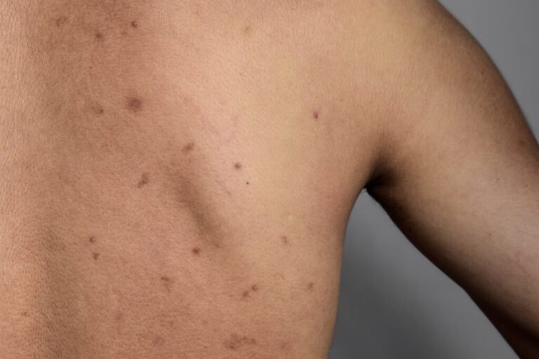 What Causes Back Acne (Bacne)