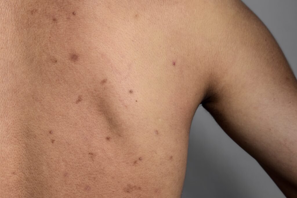 What Causes Back Acne (Bacne)