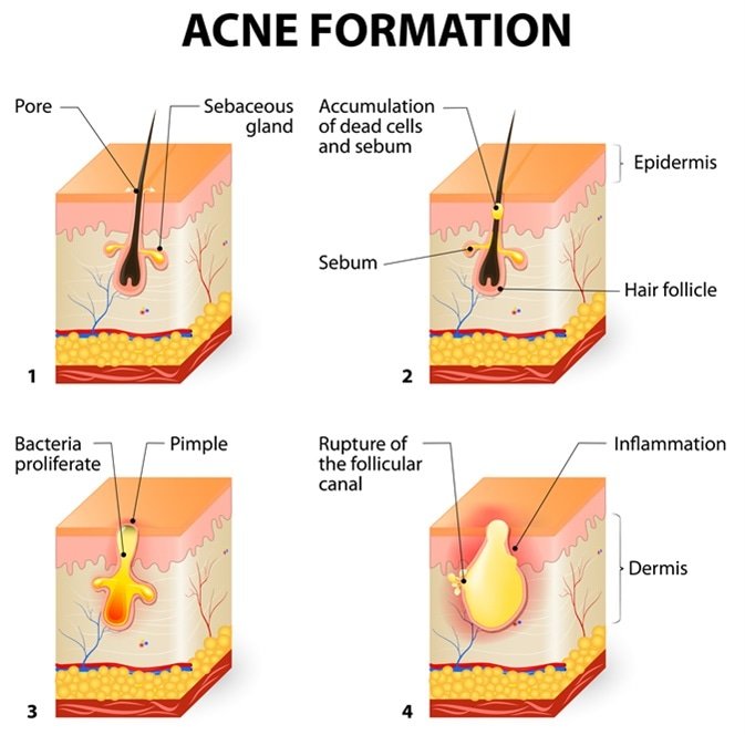 How Can I Prevent Acne Naturally