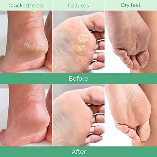 Best Foot Peeling Mask