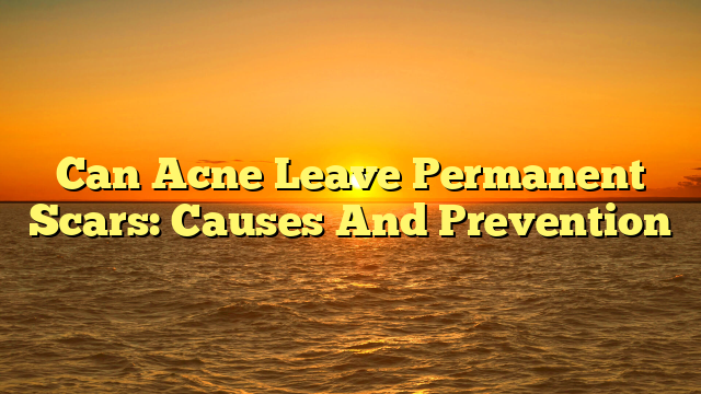 Can Acne Leave Permanent Scars: Causes And Prevention