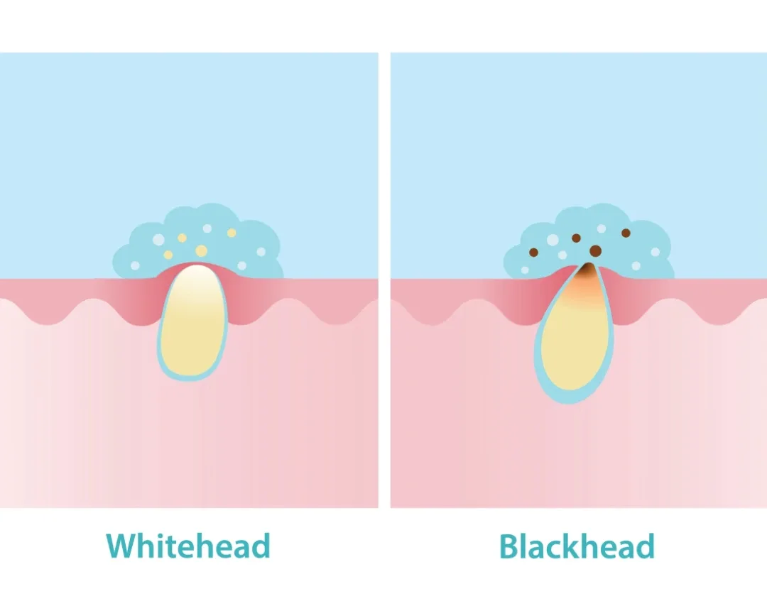 Blackheads vs. Whiteheads: What's the Difference?