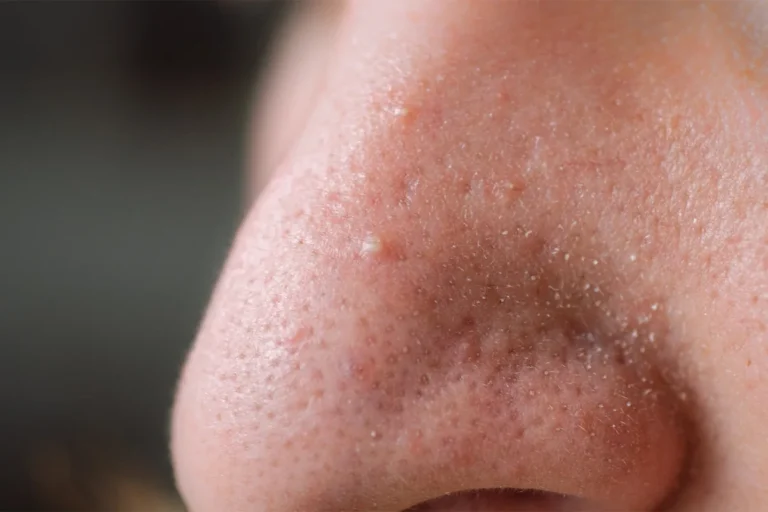 Clogged Pores