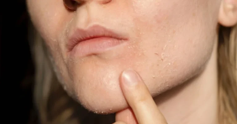 Combination Skin