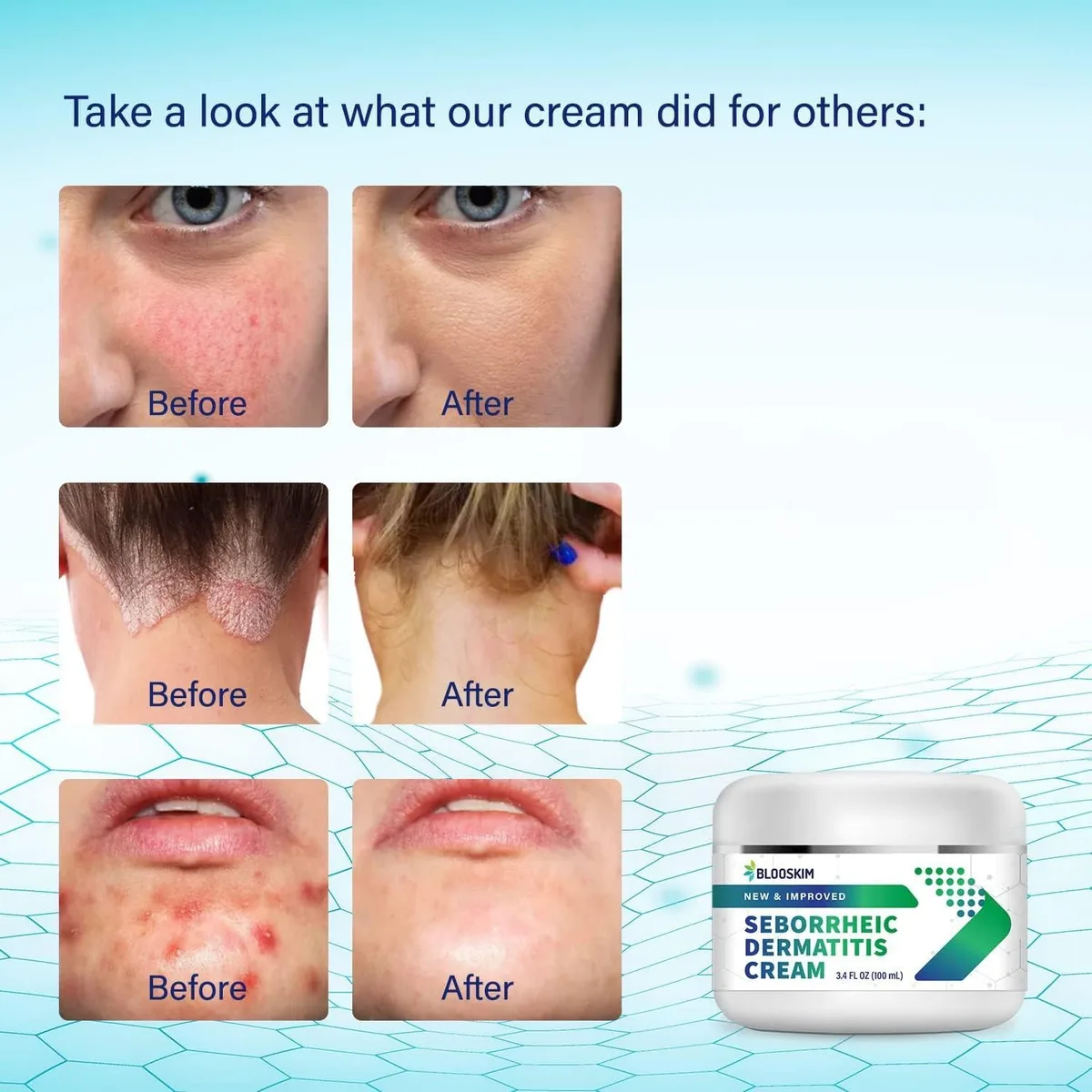 Cream vs Ointment