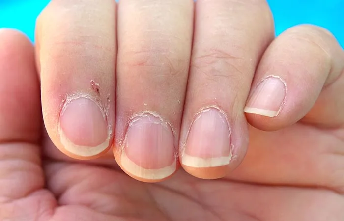 dry cuticles