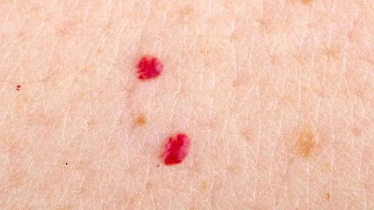 How can I reduce the appearance of acne marks?