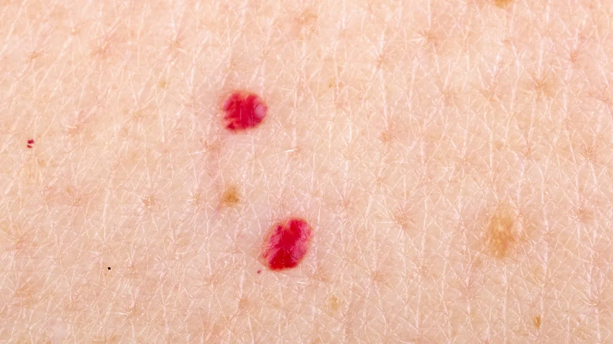 How can I reduce the appearance of acne marks?