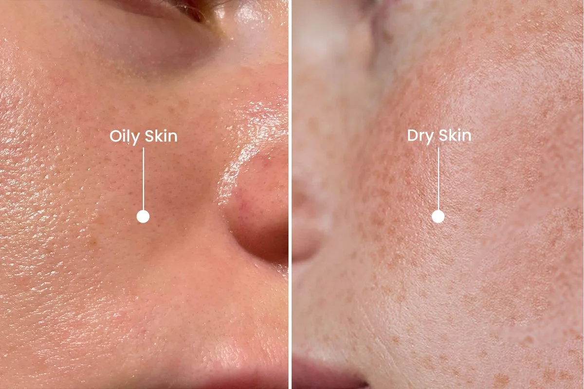 Oily & Acne-Prone Skin