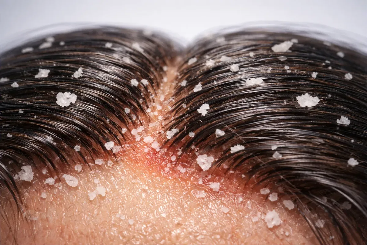 Oily Hair: Rethinking the Routine