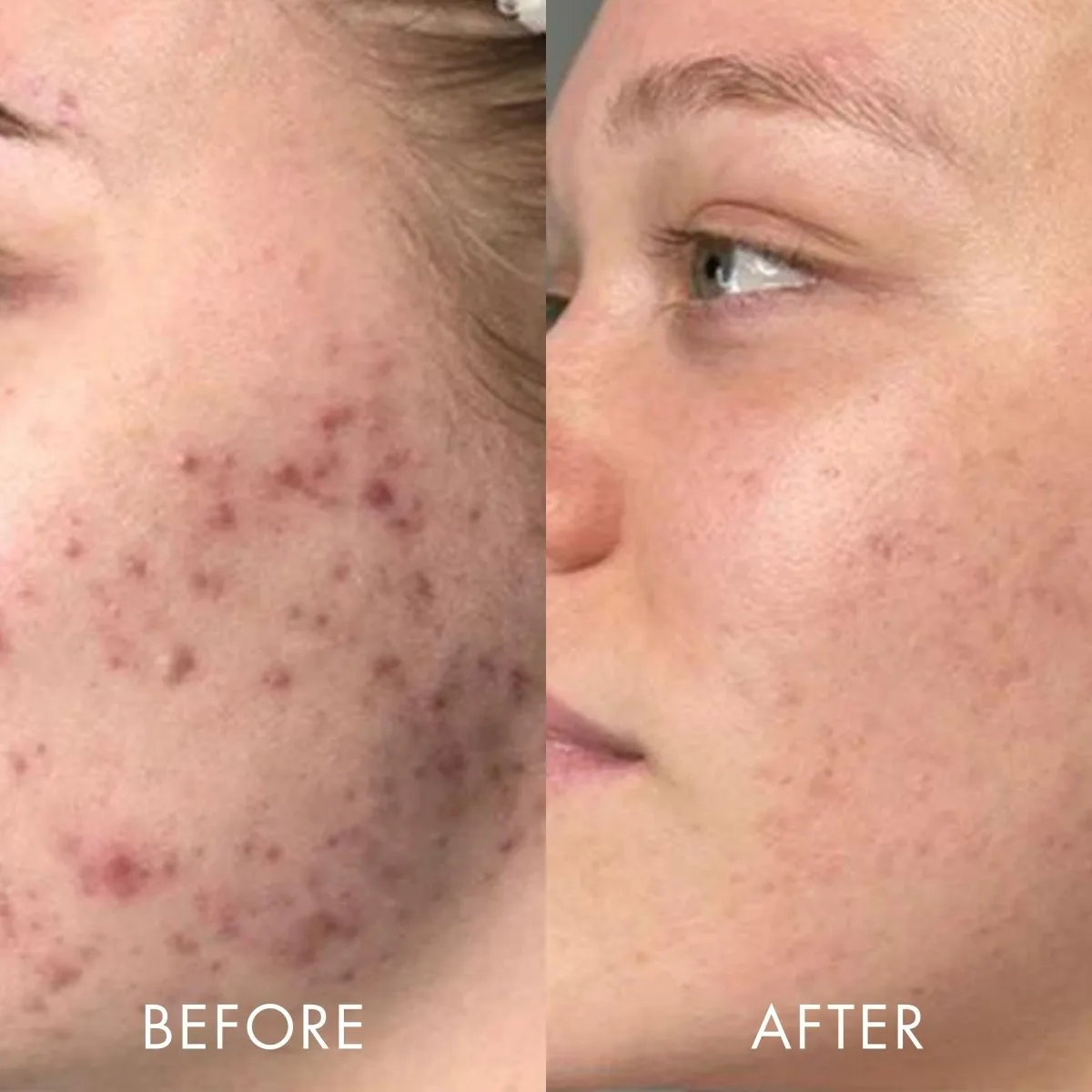 Oily or Combination Skin: The Potential Win
