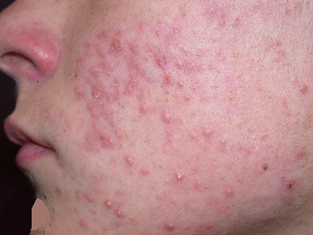 Post-Inflammatory Erythema (PIE): The Red Reminders