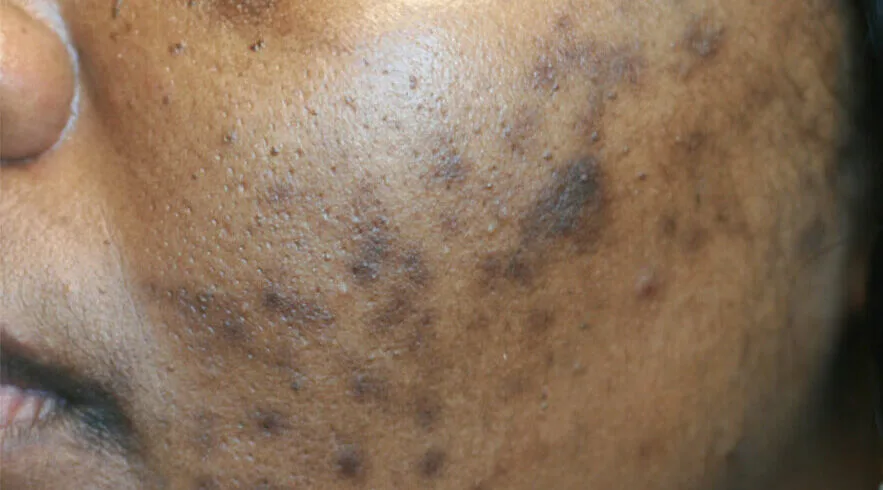 Post-Inflammatory Hyperpigmentation (PIH): The Brown Reminders