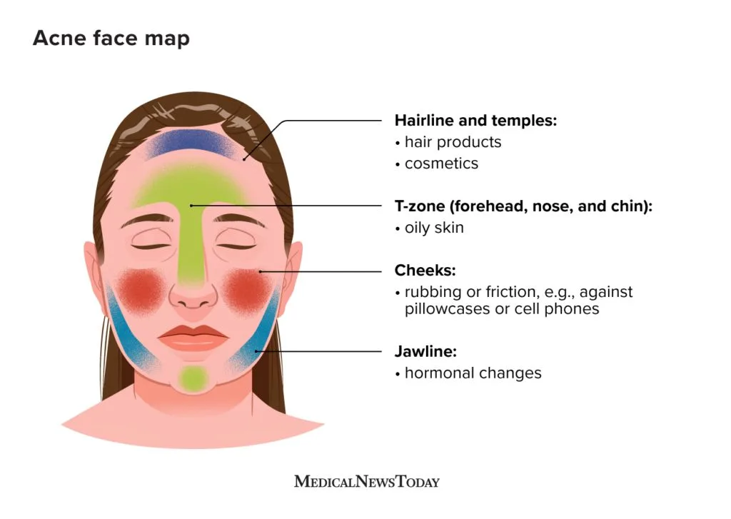 What causes facial breakouts?